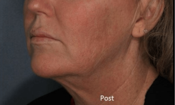 chin without fat