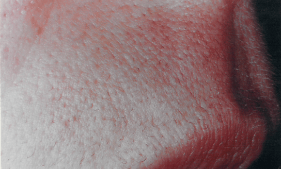patch of skin without hair