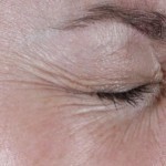 eye with wrinkles