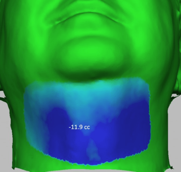 heatmap of double chin