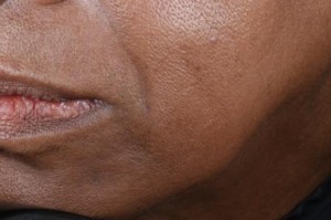 woman after filler