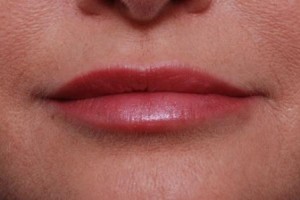 after lip filler