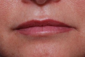 woman before lip filler