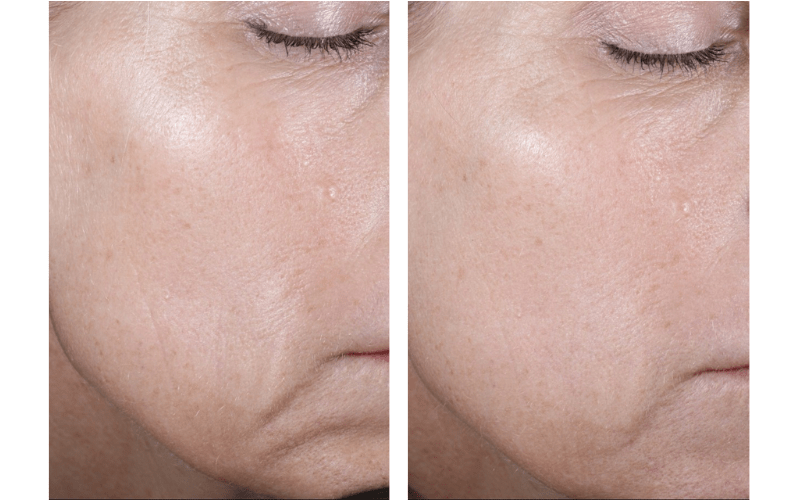 Juvederm before vs after photo