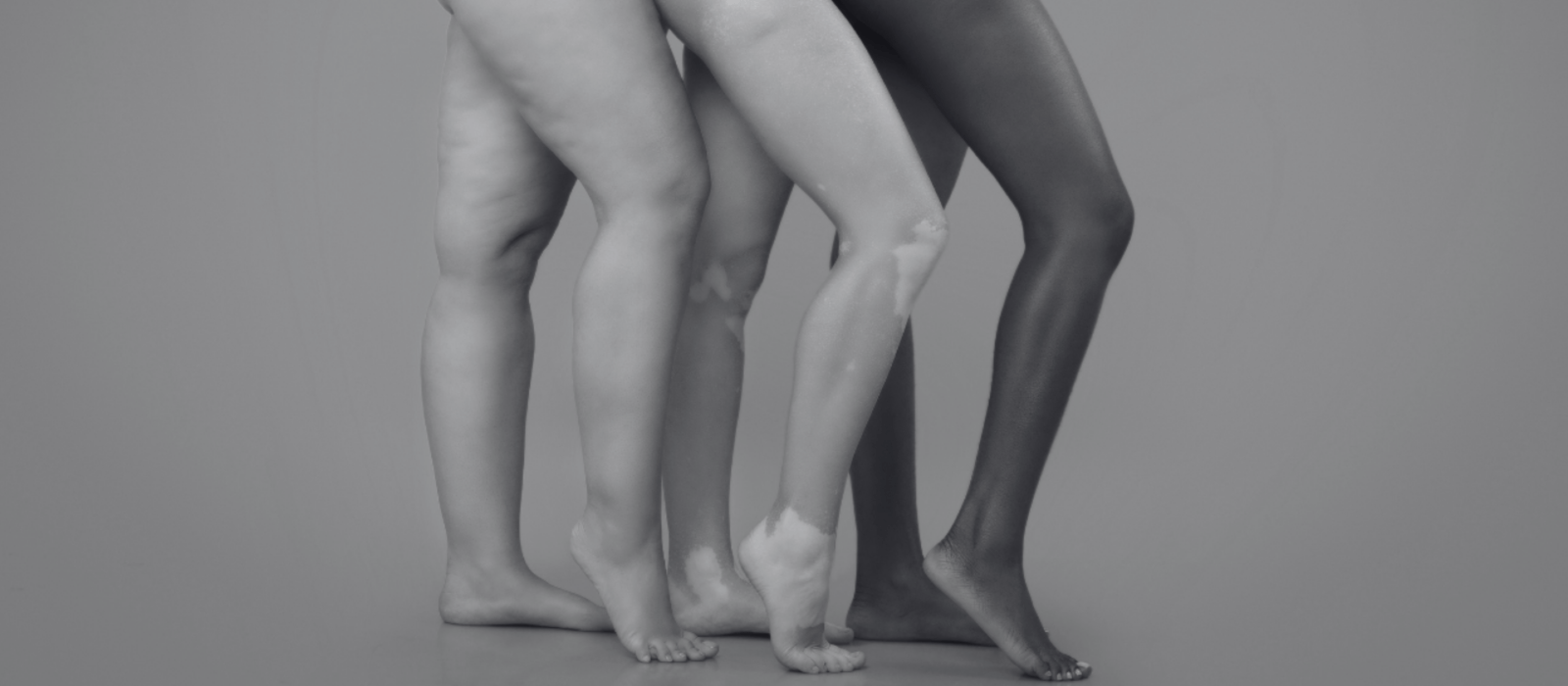 3 women with leg stretch marks