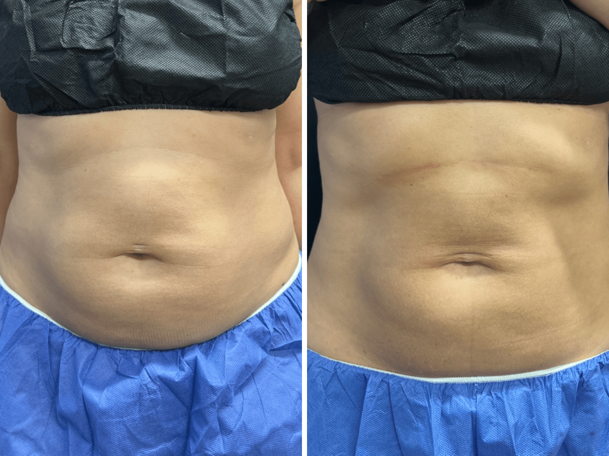 before and after coolsculpting treatment