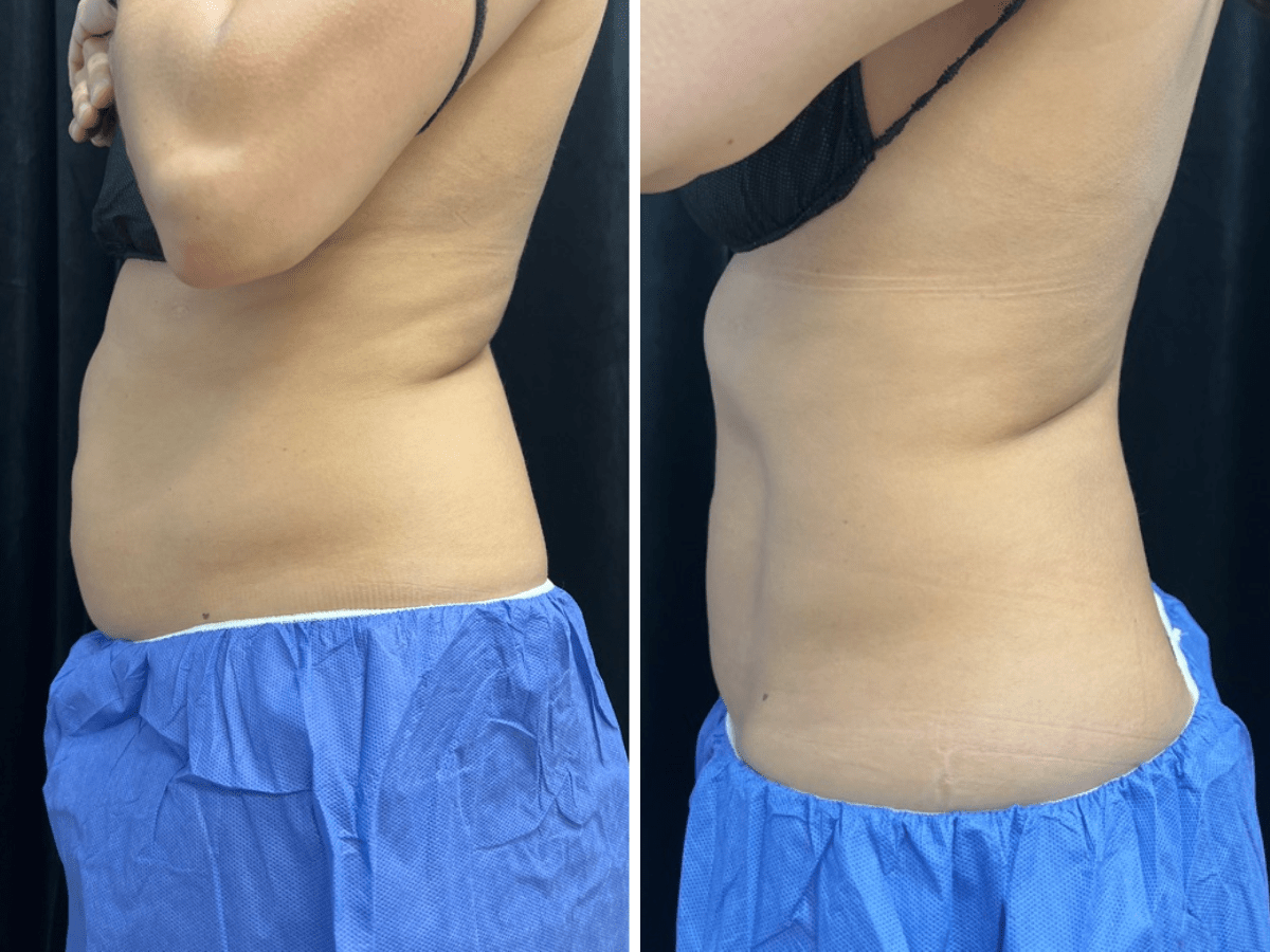 before and after coolsculpting treatment