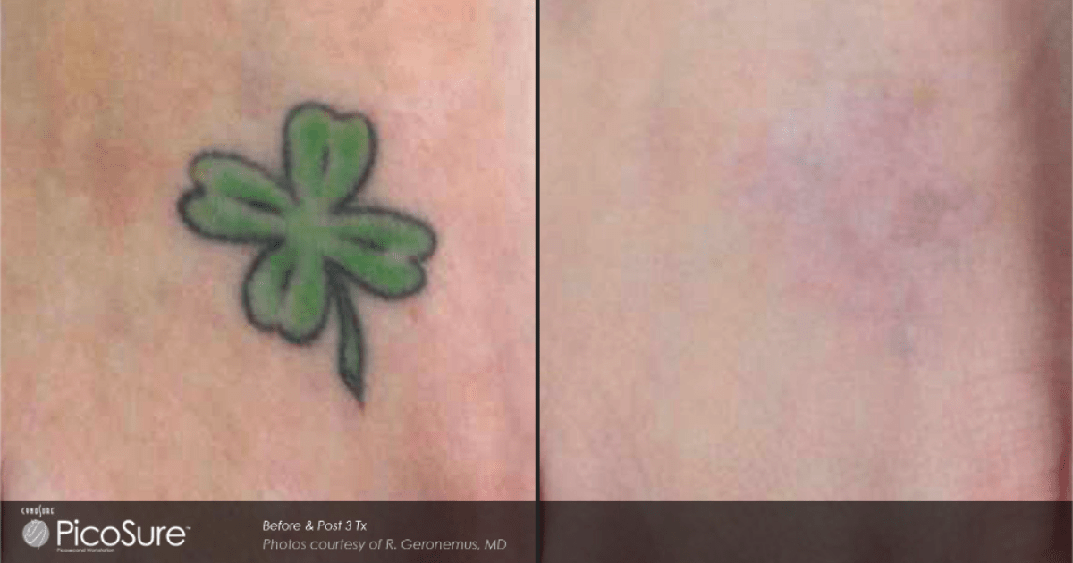 before and after of laser tattoo removal