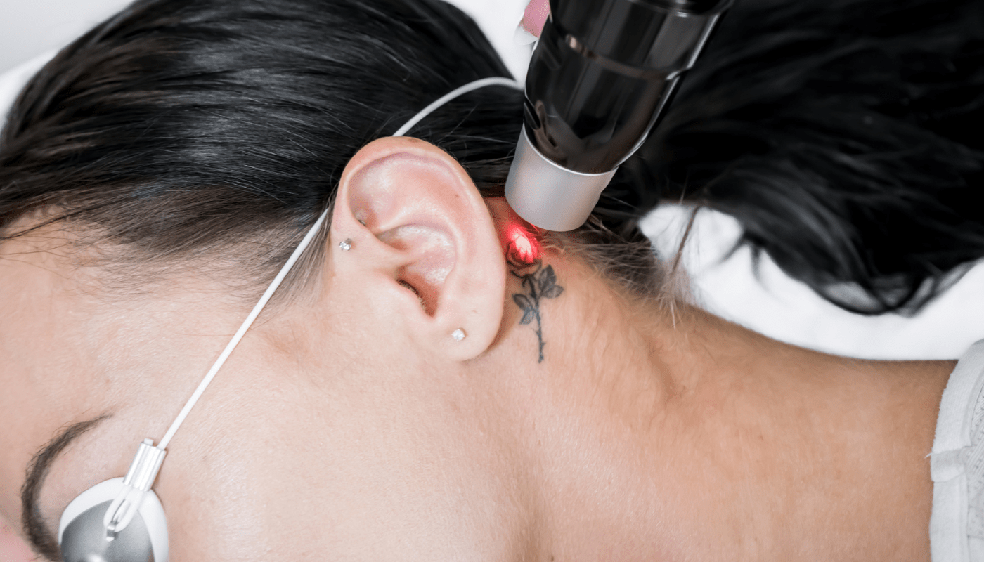 removing a tattoo with laser procedure